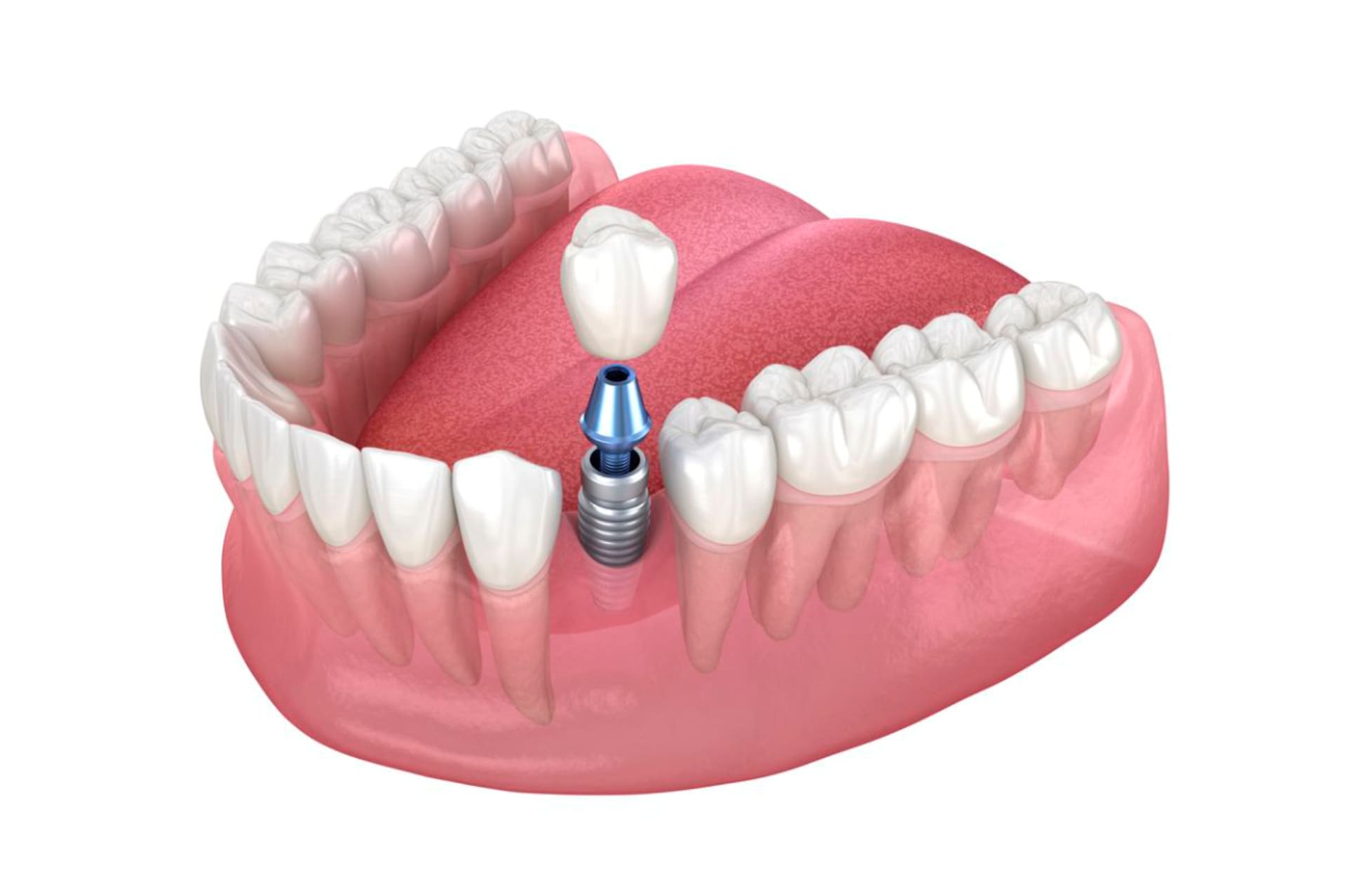 Implante Dental